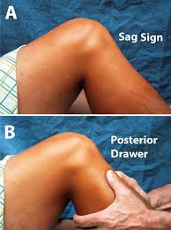 Image result for PCL Sag Test