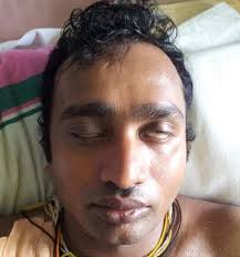 Fourth day of illness—showing bilateral lower motor facial nerve palsy...