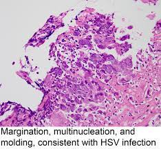 Velvet mucosa on endoscopy becomes barrett's epithelium when histology features columnar metaplasia. Pathology Outlines Herpes Simplex Esophagitis