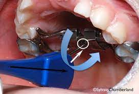 Https Mashoufortho Blog 2017 12 19 How Do I Turn The Expander What Can My Child Eat With An Expander How Do I Cle Braces Food Children Eating Palate Expander