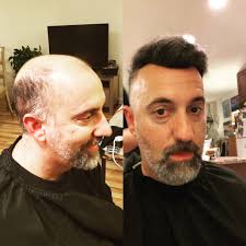 Sandra on invati™ solutions for thinning hair. Tips For Treating Your Thinning Hair In The Best Way