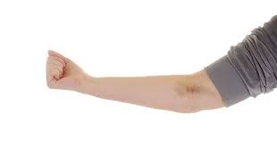 Morluk Nasil Gecer Morluklara Morarmaya Ne Iyi Gelir Dogal Tedavi