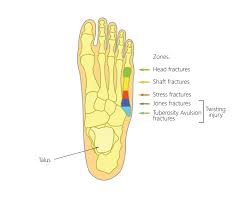 The fifth metatarsal bone is the most common metatarsal bone to be fractured in sudden (acute) injury to the foot. Fifth Metatarsal Fractures Upswing Health