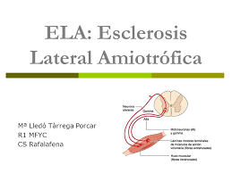 La esclerosis lateral amiotrófica (ela) es la enfermedad degenerativa de las neuronas motoras más frecuente en el adulto. Ela Esclerosis Lateral Amiotrofica Ppt Video Online Descargar