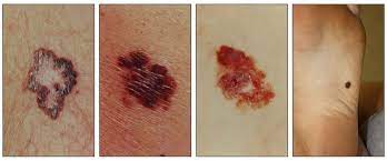 If you have skin cancer, it is important to know which type you have because it affects your treatment options and your outlook (prognosis). Genetics Of Skin Cancer Pdq Health Professional Version National Cancer Institute