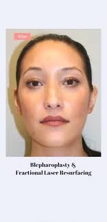 Blepharoplasty & fractional laser resurfacing transformation by Dr. Jill  Hessler from Palo Alto, California