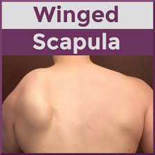 Image result for Winged Scapula