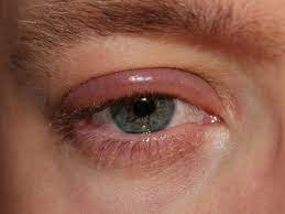 Et là il a l'épaule très gonflé au niveau de la piqure du vaccin, ça fait de pentacoq (plaque inflammée rouge bordeaux tte dure qui laissait. Paupiere Gonflee Comment Ca Se Fait Estelle Tendances