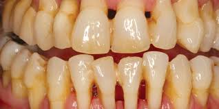 Image result for Periodontitis