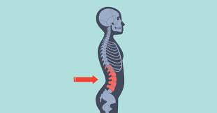 Hyperlordosis Fix: Strengthen and Stretch at Home | Dr. Body Gadget