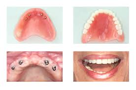 These dentures are held permanently in place by fixing them to between 2 to how much do partial dentures cost? All On 4 Dental Implants In Nyc Cost Information