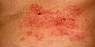 Gürtelrose dies ist eine schmerzhafte erkrankung der haut, verursacht durch einen virus namens herpes zoster. Inkubationszeit Der Gurtelrose