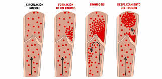 En un principio se puede ver que las venas varices aumentan de tamaño hasta convertirse en una es primordial ofrecerles la atención oportuna, ya que son el primer paso para una posterior trombosis profunda y, además, puede acabar en. Trombosis Embolia Infarto