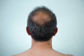C'est une situation qui n'est pas forcément facile à vivre, puisqu'elle touche à déterminez la cause de la chute de vos cheveux. Traitement De La Calvitie Plusieurs Solutions Existent Planete Sante