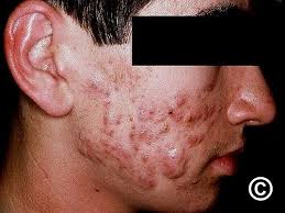 Image result for acne face