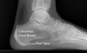 Bone spurs develop in areas of inflammation or injury of nearby cartilage or tendons. Plantar Fasciitis And Bone Spurs Orthoinfo Aaos