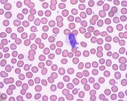 Check spelling or type a new query. ç™½è¡€ç—… Wikipedia