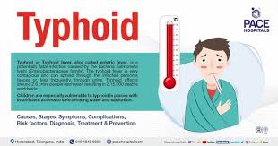Image result for Typhoid Fever