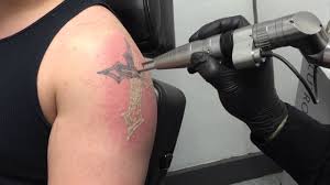 For a permanent tattoo, the tattoo artist will inject tattoo ink, which contains tiny colorful particles, into the dermis layer of the skin. New Technology Makes Laser Tattoo Removal Faster More Effective And Less Painful Youtube