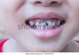 Boys Love Eat Candy Which Causes Stock Photo Edit Now 514135243