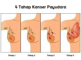 Kondisi penuaan, hormon, dan faktor lain juga bisa memengaruhi perubahan pada payudara. Wanita Ini Disahkan Bebas Dari Kanser Payudara Dalam Masa 3 Minggu Mengejutkan Doktor