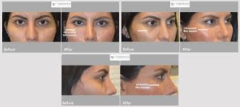 Customized Infraorbital Rim Implant Beverly Hills