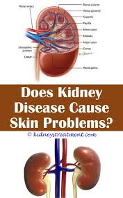 The prevalence of kidney stones in the united states. Chronic Kidney Disease Cats Kidney Disease Kidney Disease Stages Kidney Disease Diet