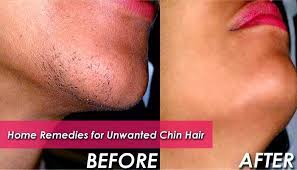 The hair removal methods below all have one thing in common: Home Remedies To Remove Unwanted Chin Hair Life Care Videos Chin Hair Chin Hair Removal Hair Remedies
