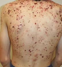 Per identificare il virus originale come vaiolo, dobbiamo sequenziarlo. Galles Caso Di Vaiolo Bovino In Un Ragazzo Bassa Irpinia News Quotidiano Online