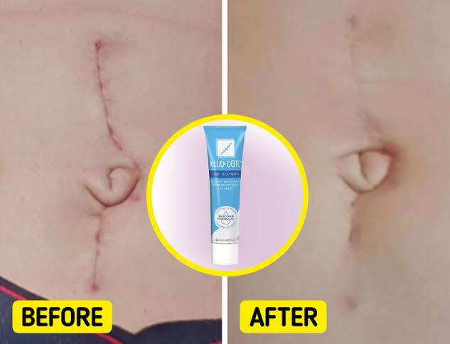 8 Amazon Products That Will Help Reduce the Appearance of Your Scars