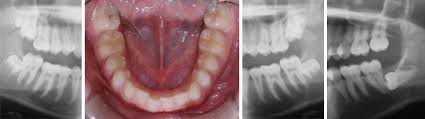 A quel âge les dents ne poussent plus? Dents De Sagesse Entre Mythes Et Realites Bucco