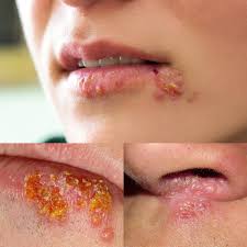 Image result for genital herpes