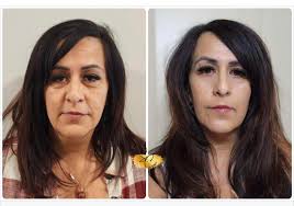 Has anyone had a NeoGen plasma treatment? A local medspa offers it. Are  these results photoshopped? They seem to good to be true. :  r/SkincareAddicts