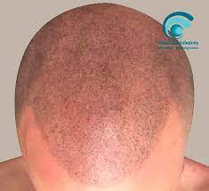 La tricopigmentazione (micropigmentazione del cuoio capelluto/smp) è un trattamento . Tricopigmentazione Micropigmentazione Capelli Tricodermsolutions