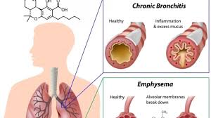 Image result for Chronic Bronchitis
