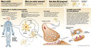 We provide care services, and we advocate on behalf. Als Outbreak Among Gulf War Veterans Likely Has Common Cause Says Leading Researcher 91outcomes Com Amyotrophic Lateral Sclerosis Motor Neuron Neurons