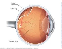 Depending on your degree of vision loss, your lifestyle might change significantly. Retinal Detachment Symptoms And Causes Mayo Clinic