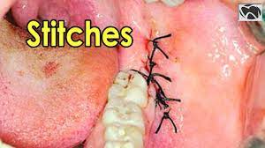 Wisdom Teeth Removal Stitches Types Of Stitches Used In Wisdom Teeth Extraction Youtube