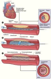 They look at the role of blood cells in our bodies, as well as how the heart, lungs, arteries and veins work together to move blood cells around the body.the questions test reading ability and comprehension, and give students the opportunity to reflect on what they've learned about blood and how. Stent Key Stage Wiki