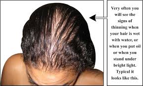 My hair does not seem to look like it is thinning.as i have a very thick head of hair. In Denial Of Hair Loss Part 4 Hair Articles By Dr Shahid Shamsher