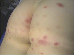 Le traitement de la cause reste la solution efficace. Dermato Info Les Infections Bacteriennes