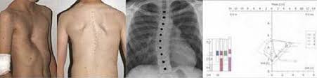 Polandův syndrom (poland syndrom) a příčiny. Brustwandfehlbildungen Universitatsklinikum Tubingen