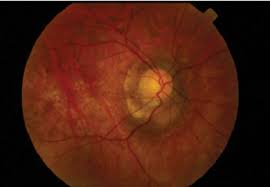 Maybe you would like to learn more about one of these? Retinal Tear Arising Adjacent To The Optic Disc A Case Report Eye