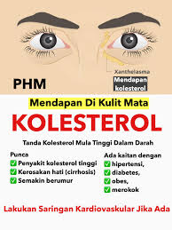 Obat darah tinggi dan kolesterol. Xanthelasma Atau Mendapan Public Health Malaysia Facebook