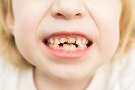 How to reverse tooth decay in babies. What Is Baby Bottle Tooth Decay Know What To Look For