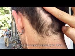 Check spelling or type a new query. Hair Transplant Scars Revealed Full Disclosure Video Dailymotion