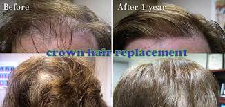 Androgenic Alopecia Is A Genetic Condition That Can Affect Both Men And Women Men With This Conditi Male Pattern Baldness Crown Hairstyles Baldness Solutions