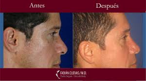 Galería Rinoplastia