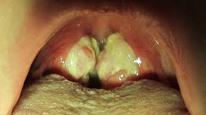 Image result for Strep throat infection roof of mouth