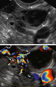 A, transverse ultrasound imaging of the left ovary demonstrates a mass of relatively homogeneous internal echoes. Duplex Ultrasound Evaluation Of The Uterus And Ovaries Radiology Key